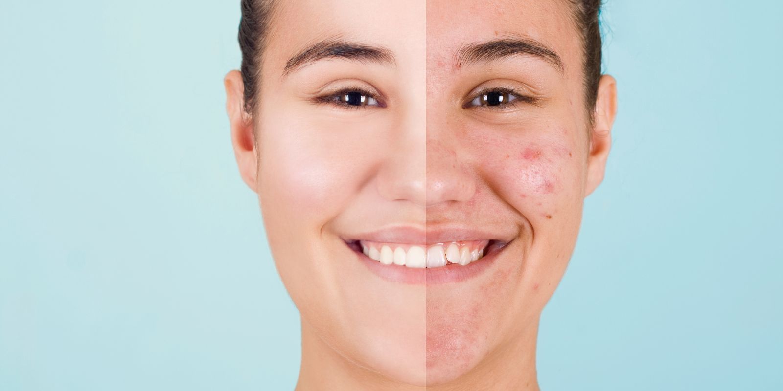 acne before and after