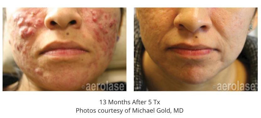 aerolase acne before and after