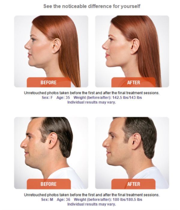 kybella before and after