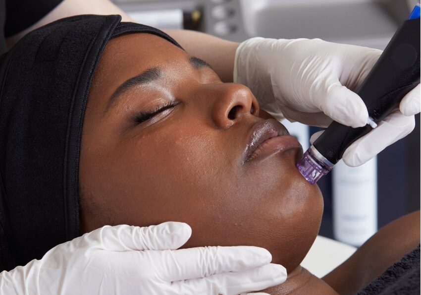 64dab831b94461ecb92068ed_hydrafacial-treatment-for-acne-and-oily-skin